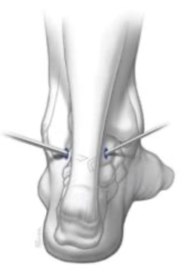 Desenho da artroscopia posterior do tornozelo para lesões da cartilagem.