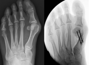 Foto do raio-x da Cirurgia minimamente invasiva do hálux valgo (joanete). 