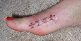 Cicatriz na pele após cirurgia de correção do Joanete.