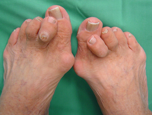 Fotografia do Joanete nos dois pés, com deformidade dos dedos em garra.