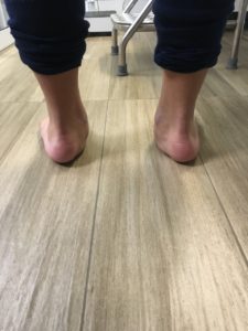 Fotografia do pé plano por trás, mostrando a deformidade do calcanhar.