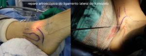 foto de tratamento com cirurgia do entorse torção do tornozelo