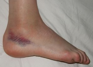 foto mostrando dor e vermelhidão após entorse do tornozelo
