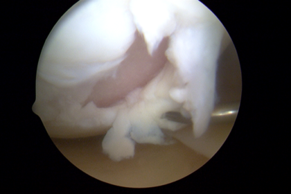 Foto da lesão da cartilagem articular durante a cirurgia de artroscopia.