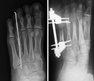 Foto de cirurgia de alongamento ósseo para braquimetatarsia.