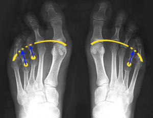 Radiografia e diagnóstico de braquimetatarsia nos dois pés.