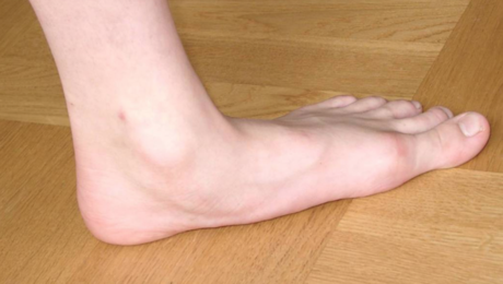 Imagem que mostra a queda do arco do pé no pé plano ou pé chato.
