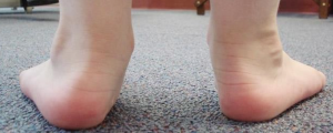 Fotografia mostrando o calcanhar e o pé plano na criança, de um lado somente.