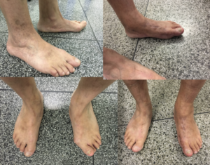 Fotografias antes e depois da cirurgia de correção do pé plano no adulto.