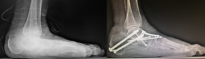 Fotografia do raio-x antes e depois da cirurgia do pé plano.