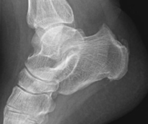 Fotografia de perfil do raio-x do Haglund na tendinite do aquiles.
