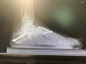 Foto do pé plano após cirurgia mostrando a correção.