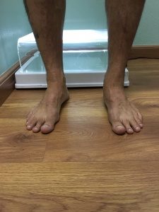 Fotografia de frente mostrando o pé plano após trauma.