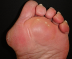 Foto que mostra as calosidades plantares na bola do pé.