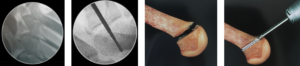 Fotografias mostrando a técnica minimamente invasiva para metatarsalgia e dedos em garra.
