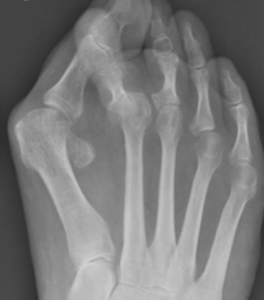 Metatarsalgia com joanete, dedos em garra e luxação da articulação metatarso-falângica.