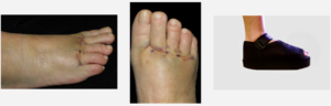 Fotografias do pé após cirurgia de metatarsalgia na sandália de baruk.