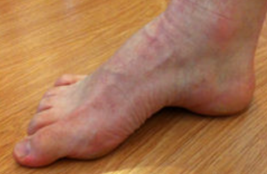 Foto do pé cavo na Metatarsalgia causando dor na bola do pé.