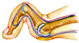 Foto mostrando dedos em garra e metatarsalgia.