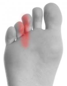 Foto mostrando o local de dor no Neuroma de Morton no pé .