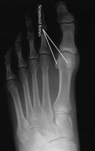 Radiografia mostrando os ossos sesamóides no pé esquerdo.