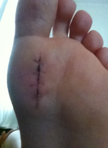 Foto demonstrando a cirurgia de sesamoidite na planta do pé.