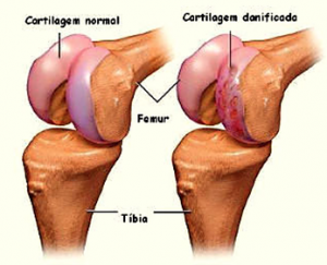 Lesão da cartilagem no joelho mostrando a superfície sadia e a com artrose.