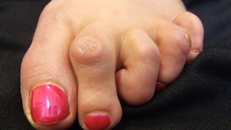 Foto dos dedos mostrando um Dedo em Garra com calosidade.