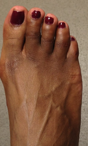 Foto após cirurgia de correção dos dedos tortos do pé.