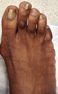 Foto dos dedos menores do pé antes da cirurgia.