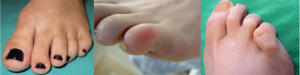 Fotos mostrando deformidades nos dedos do pé com o dedo aduto-varo.