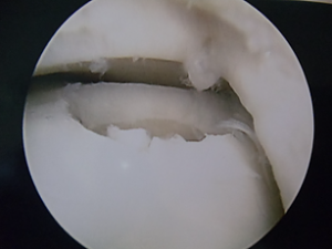 Foto da cartilagem articular lesada durante a artroscopia do tornozelo.