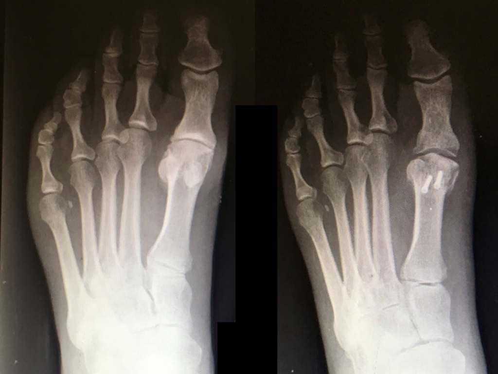 Foto de raio-x do Hálux Rígidus mostrando o resultado final.