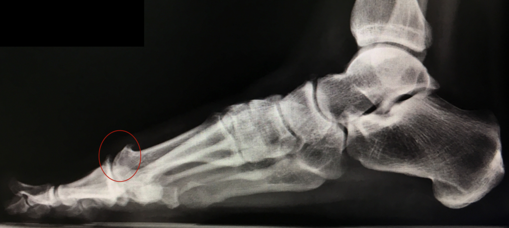 Foto de perfil do raio-x do Hálux Rígidus mostrando a causa da dor pelo osteófito.