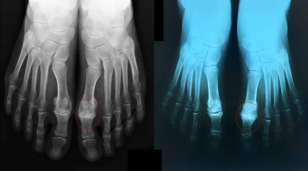 Foto de raio-x do Hálux Rígidus Hálux Rígidus mostrando a artrose no hálux.