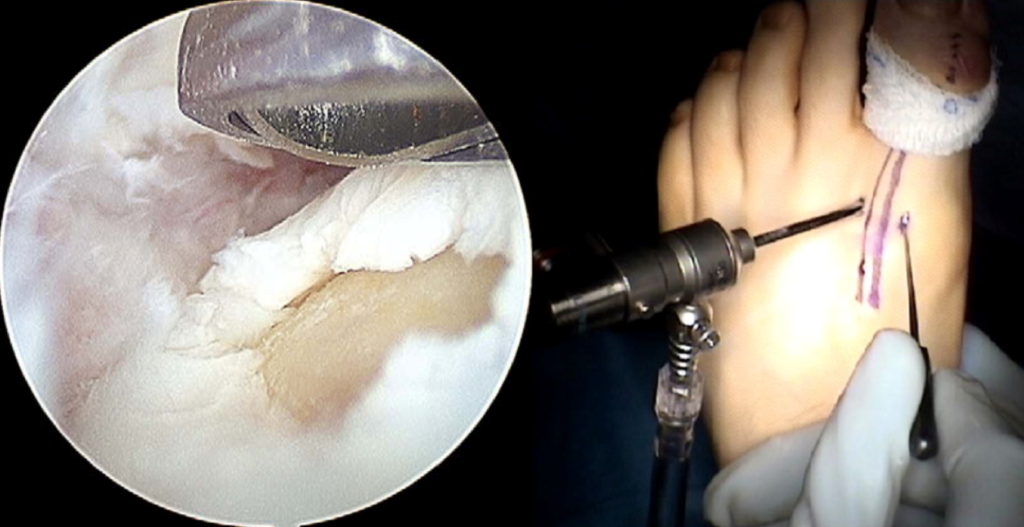 Foto de cirurgia de artroscopia para o Hálux Rígidus mostrando a técnica.