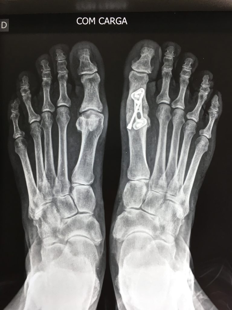 Foto de Raio-x do Hálux Rígidus mostrando o resultado da cirurgia.