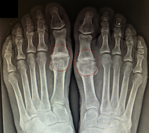 Foto do raio-x dos pés com Hálux Rígidus bilateral que ocasiona as dores.