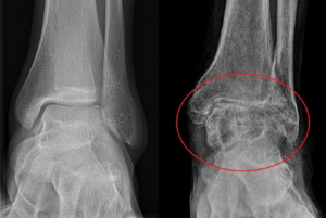 Radiografia mostrando osteoartrose do tornozelo normal e o doente.
