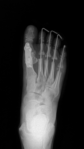 Raio x de cirurgia para tratamento dos casos graves de artrite no antepé e nos dedos 