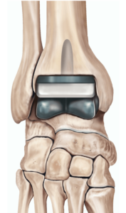 Desenho mostrando a prótese de tornozelo na visão de frente